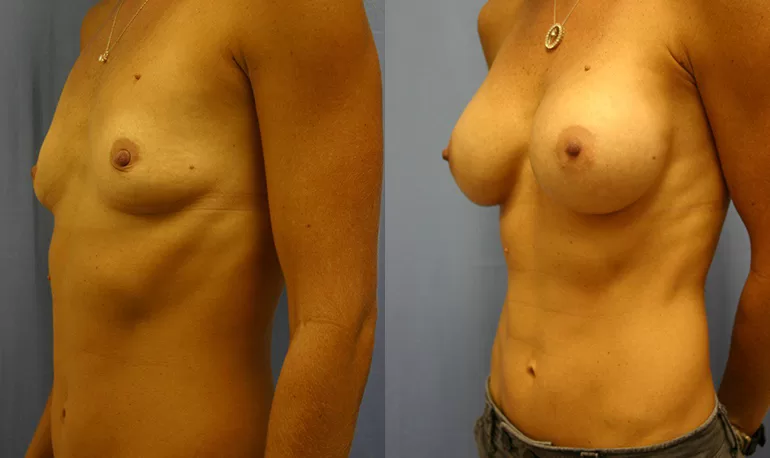Patient 1a breast augmentation before and after