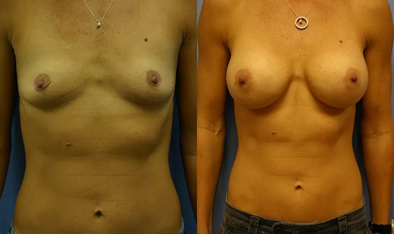 Patient 1b breast augmentation before and after