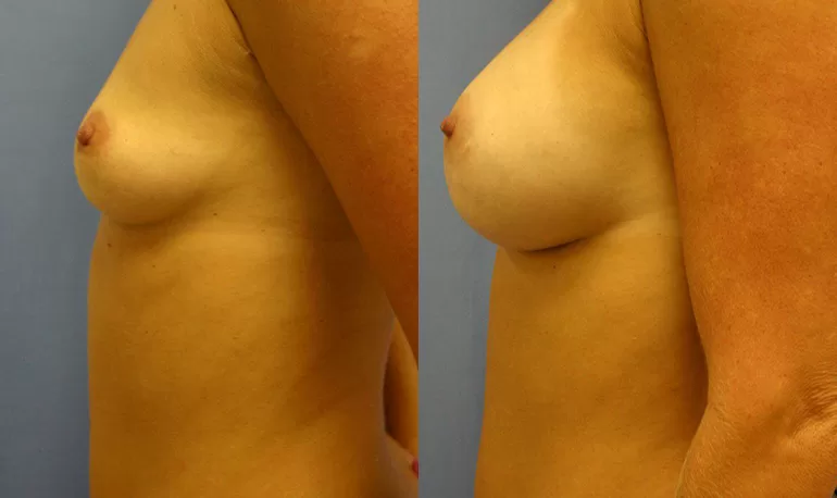 Patient 2a breast augmentation before and after