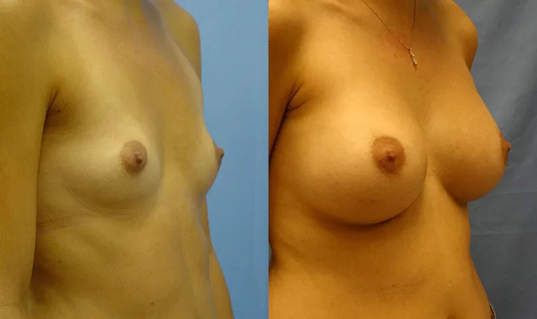 Patient 3a breast augmentation before and after