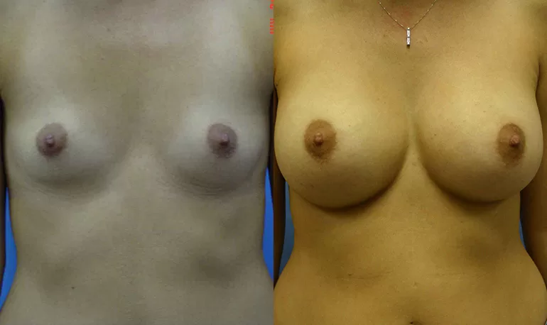 Patient 3b breast augmentation before and after