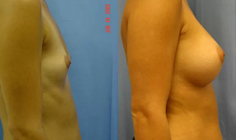 Patient 3c breast augmentation before and after