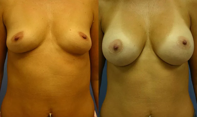 Patient 4a breast augmentation before and after