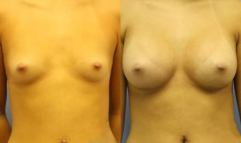 Patient 4b breast augmentation before and after