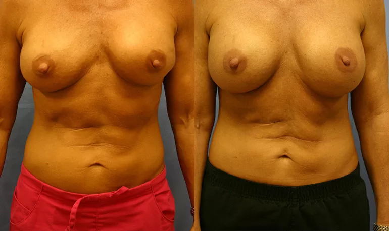 Patient 5a breast augmentation before and after