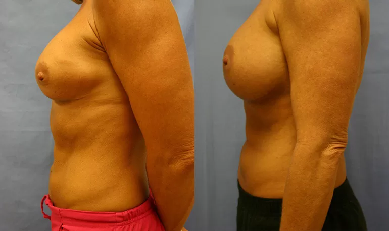 Patient 5b breast augmentation before and after