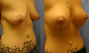 Patient 1a Breast Lift Before and After