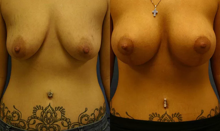 Patient 1b breast lift before and after