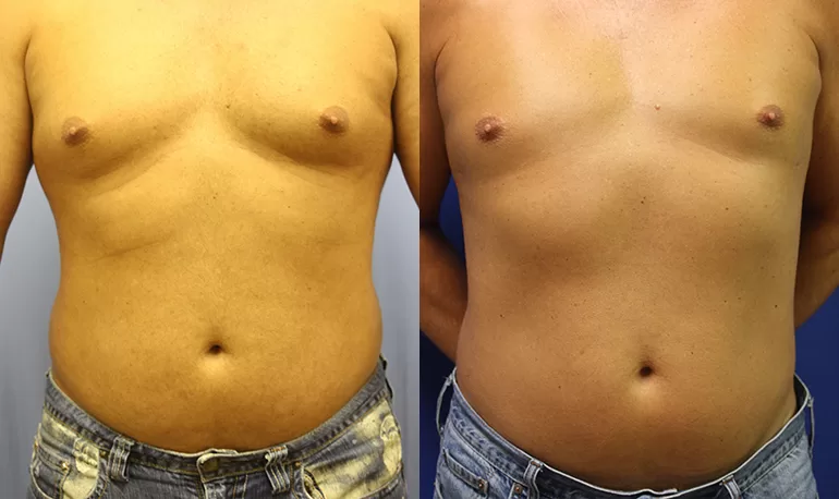 Patient 5a liposuction before and after