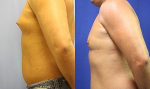 Patient 5b Liposuction Before and After