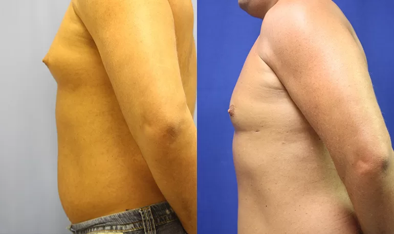 Patient 5b liposuction before and after