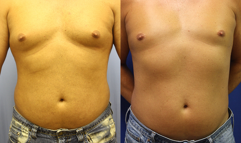 Patient 5a Liposuction Before and After
