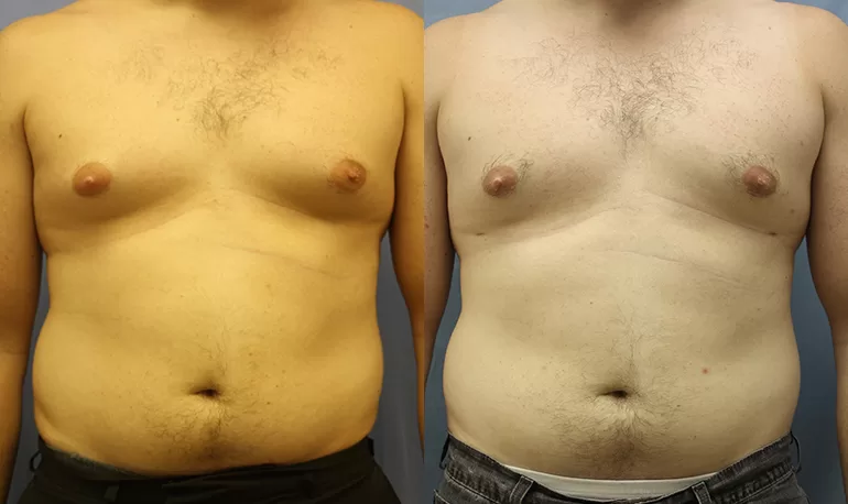 Patient 6a liposuction before and after
