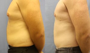 Patient 6b Liposuction Before and After