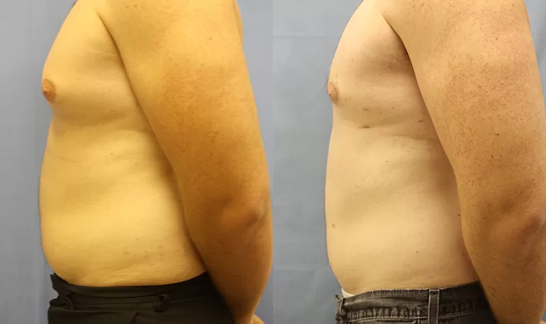 Patient 6b liposuction before and after