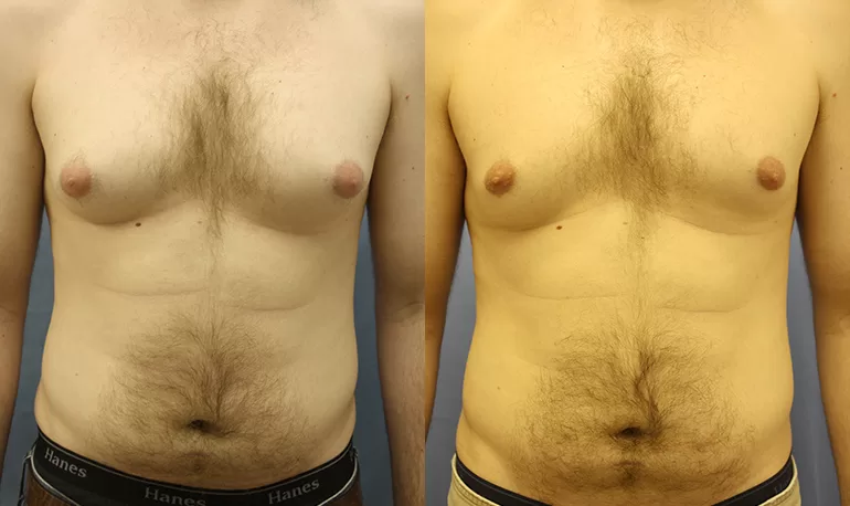 Patient 7a liposuction before and after