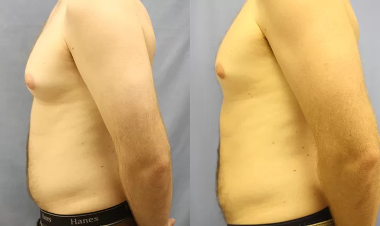 Patient 7b liposuction before and after