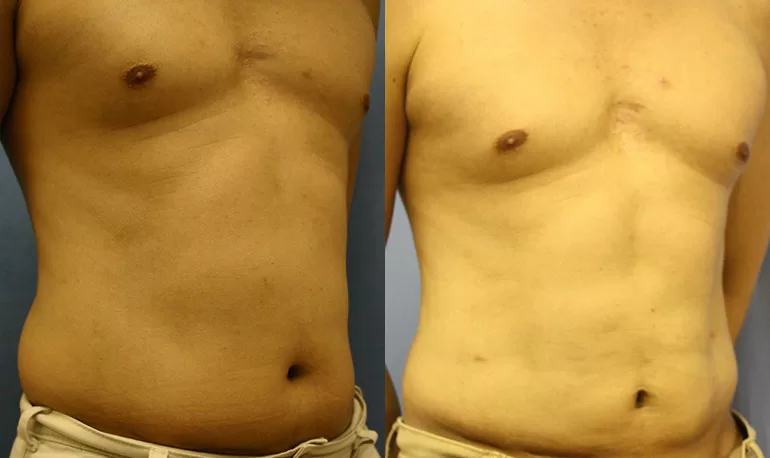Patient 1a liposuction before and after
