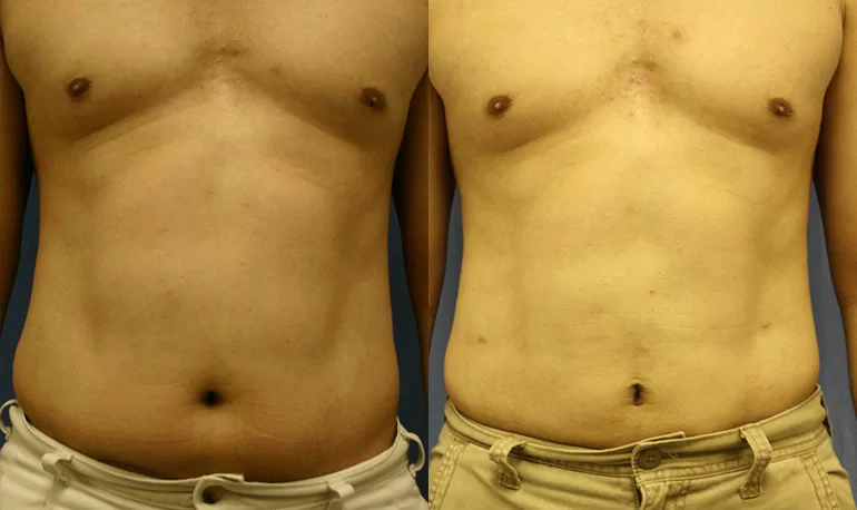 Patient 1b liposuction before and after