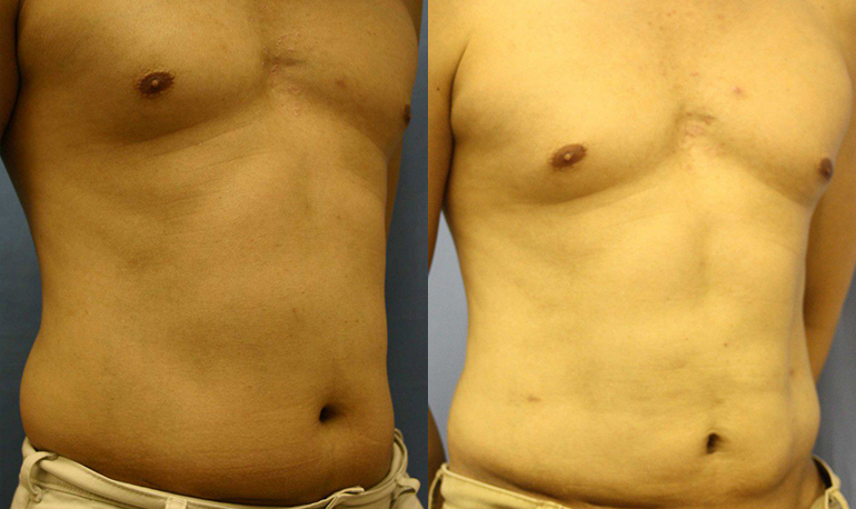 Patient 1a Liposuction Before and After