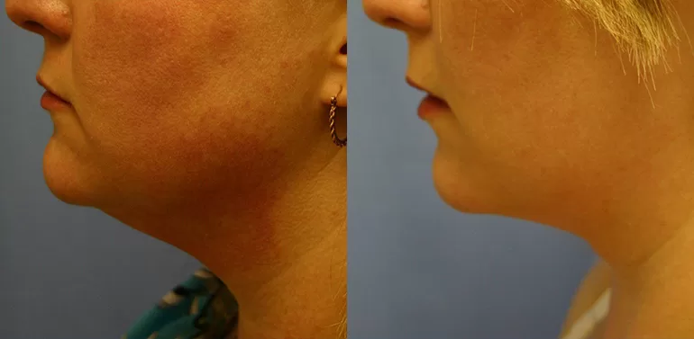 Patient 2 liposuction before and after