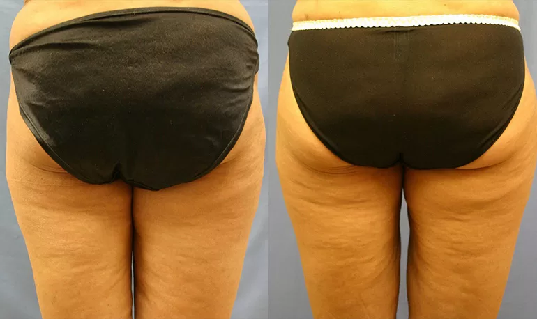 Patient 3a liposuction before and after