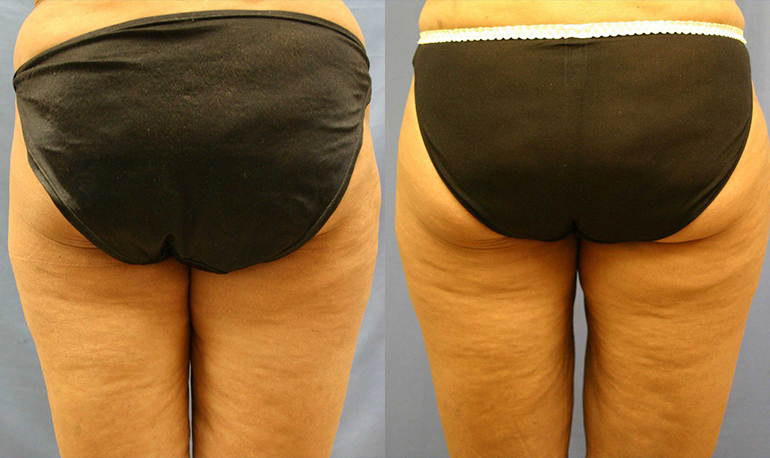 Patient 3a Liposuction Before and After