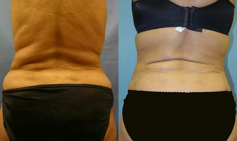Patient 3b liposuction before and after