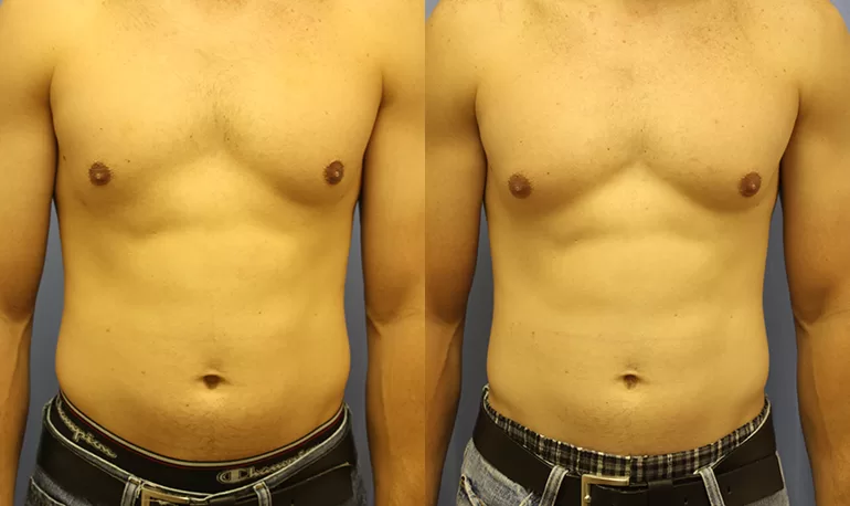 Patient 4a liposuction before and after