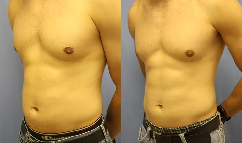 Patient 4b liposuction before and after