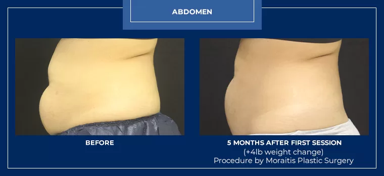 Moraitis coolsculpting patient 22a