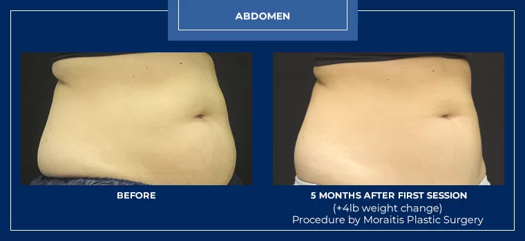 Moraitis coolsculpting patient 22b