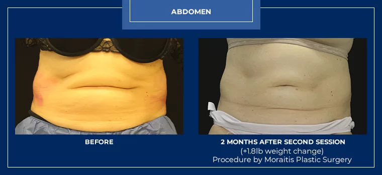 Moraitis coolsculpting patient 23a
