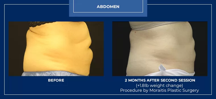 Moraitis coolsculpting patient 23b