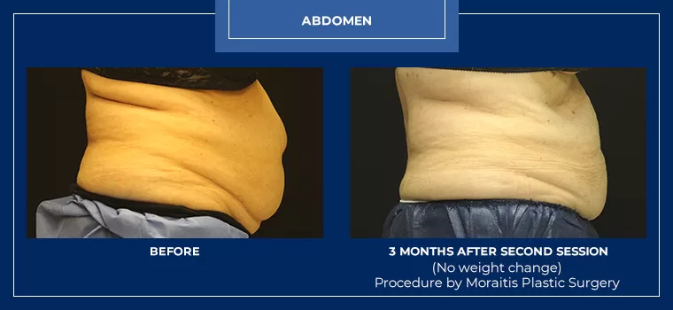 Moraitis coolsculpting patient 24a