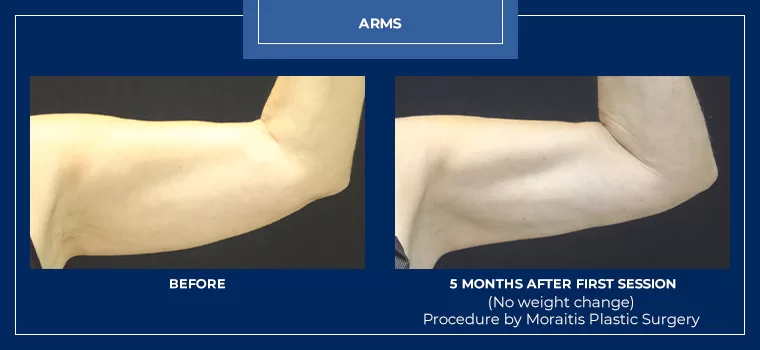 Moraitis coolsculpting patient 25a