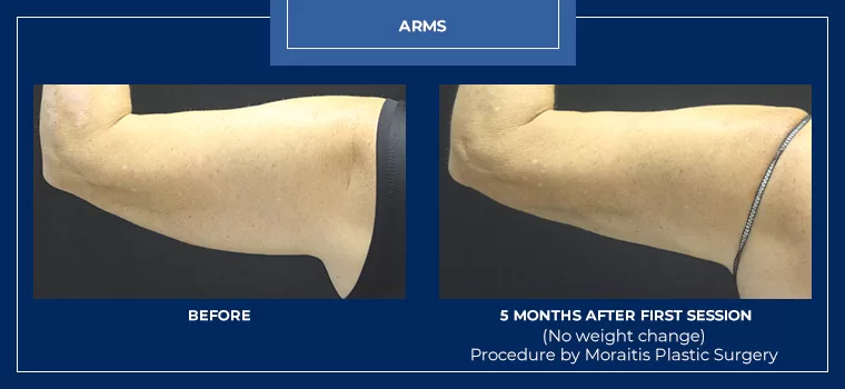 Moraitis coolsculpting patient 25b