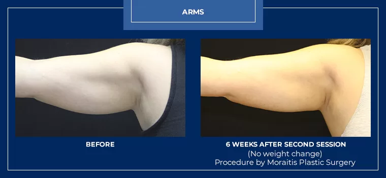 Moraitis coolsculpting patient 26a