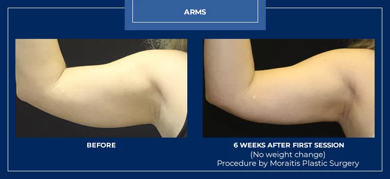 Moraitis coolsculpting patient 26b
