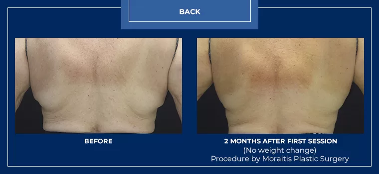 Moraitis coolsculpting patient 27b