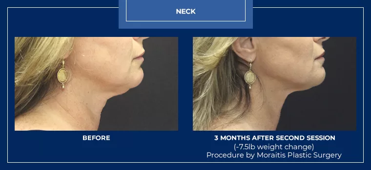Moraitis coolsculpting patient 28