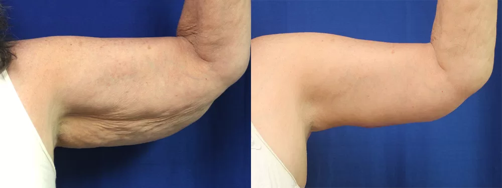 Moratis plastic surgery arm lift patient 10