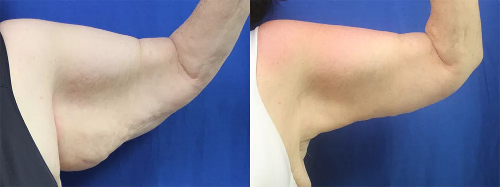 Moratis plastic surgery arm lift patient 3