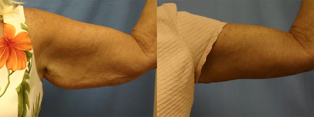 Moratis plastic surgery arm lift patient 4