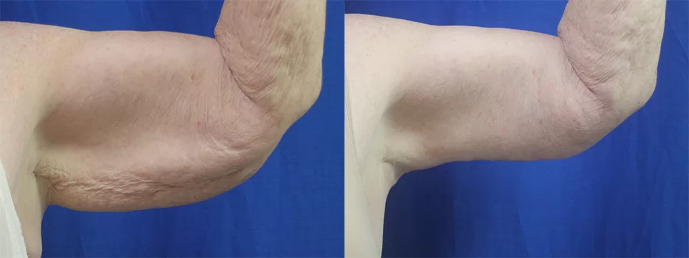 Moratis plastic surgery arm lift patient 5