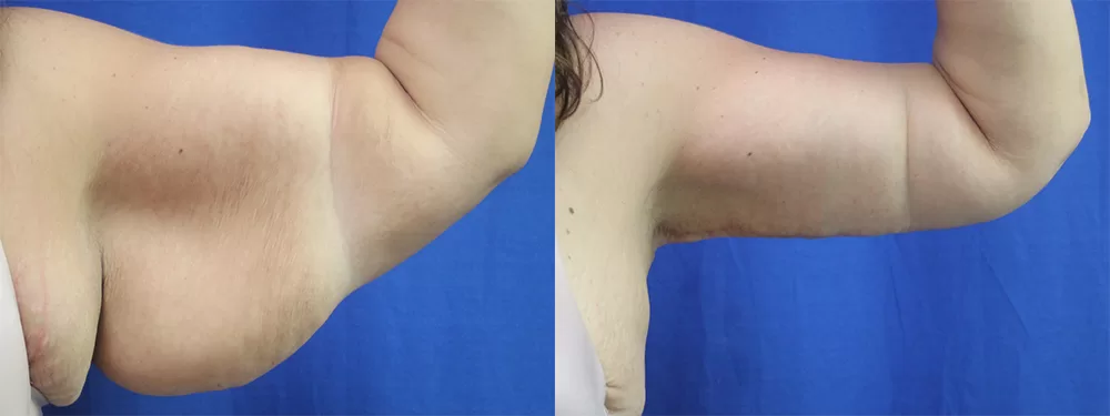 Moratis plastic surgery arm lift patient 7