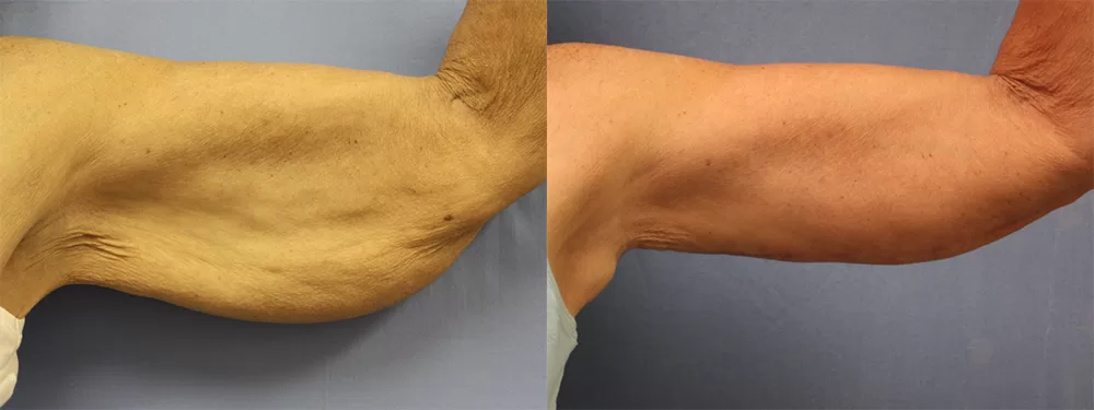 Moratis plastic surgery arm lift patient 8