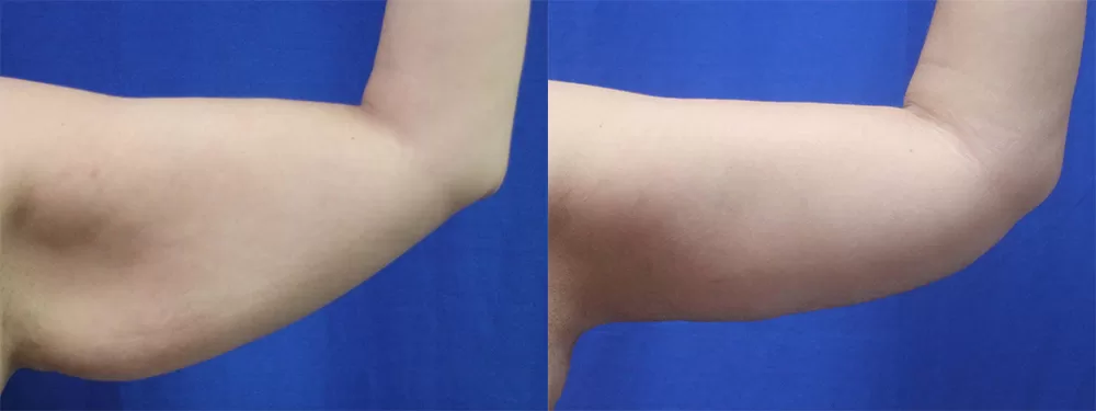 Moratis plastic surgery arm lift patient 9