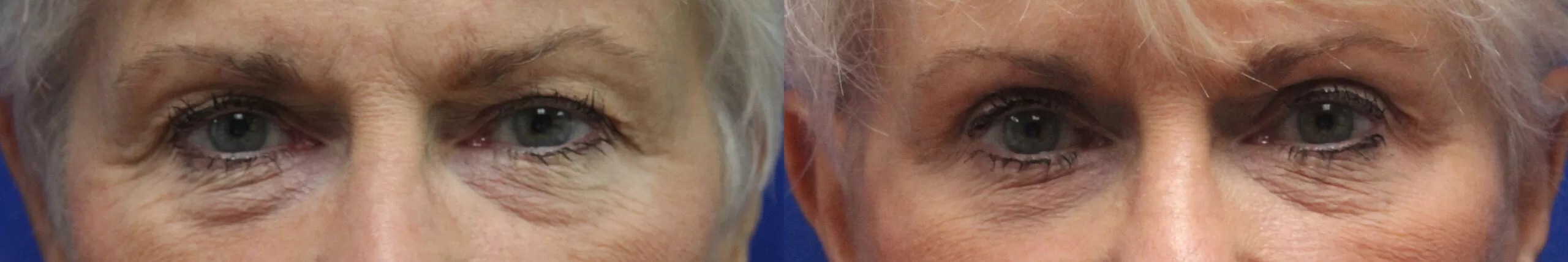 Moratis plastic surgery blepharoplasty patient 10