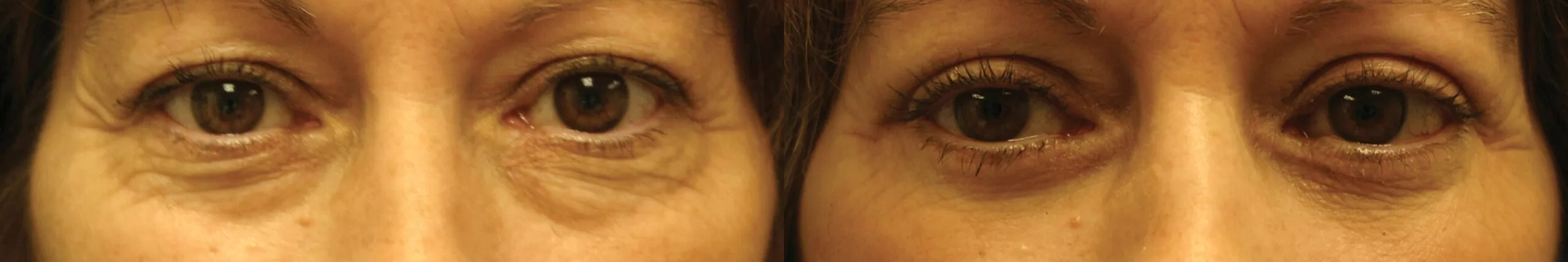 Moratis plastic surgery blepharoplasty patient 11